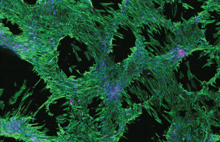 Intertwined Pathways: Revealing the Intricate Fibrosis Landscape in Human Liver Tissue - by Bobby Boumelhem
