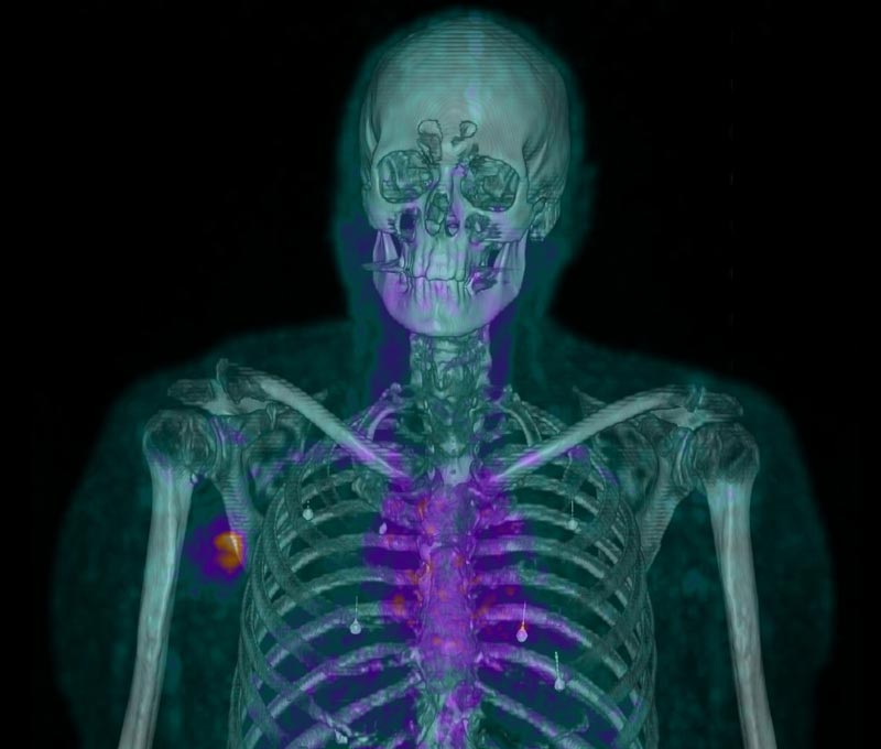 An-unprecedented-look-at-tumour-biology Philip-Hogg